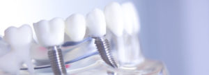 Dental implant model close-up with surrounding teeth.