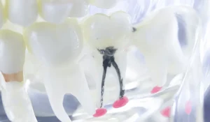 Root Canal