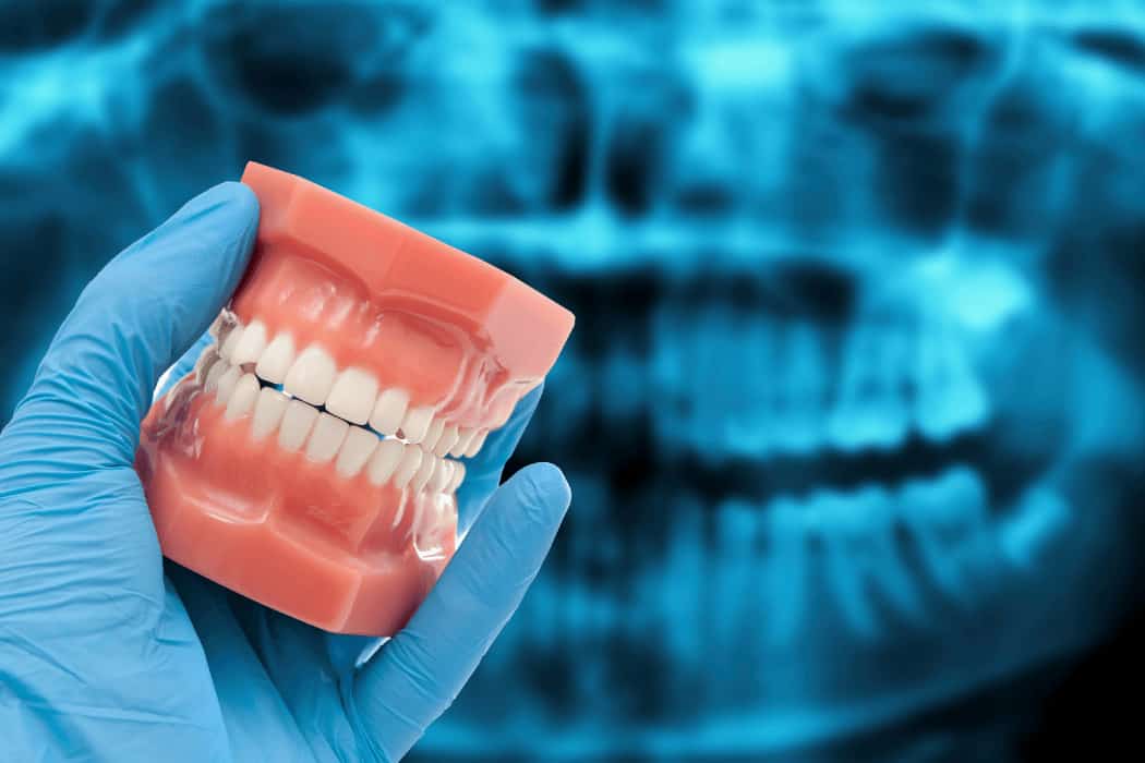 Palatal Crib (1)