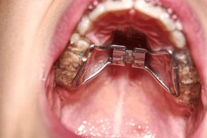 Palatal Crib