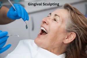 Gingival Sculpting (1)