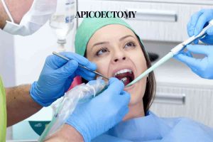 Apicoectomy (1)