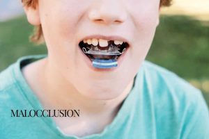 Malocclusion