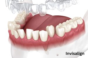 Invisalign