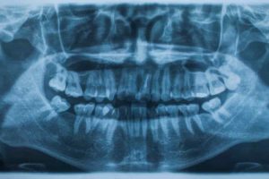 Dental X-Rays