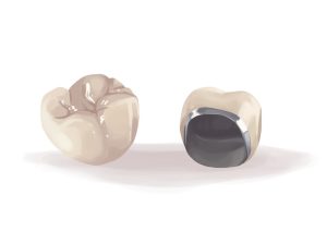 Teeth with dental crowns illustrating crown application in dental care.