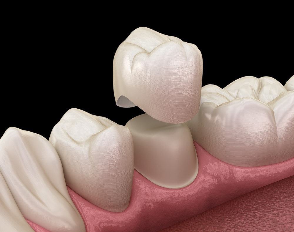 A tooth with a dental crown, symbolizing restoration and protection.