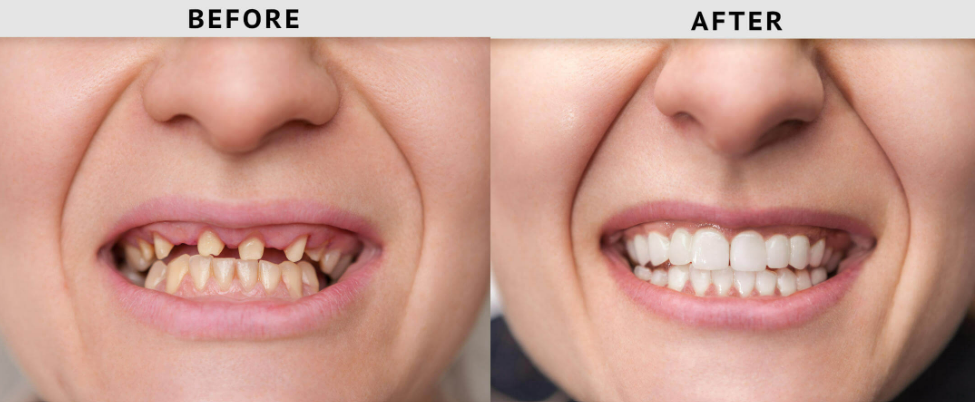 Before and after images of a full mouth reconstruction with teeth whitening.