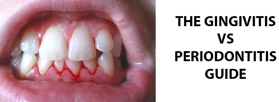 Gingivitis vs Periodontitis
