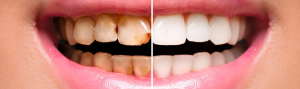 A woman's teeth before and after whitening, showing full mouth reconstruction results.