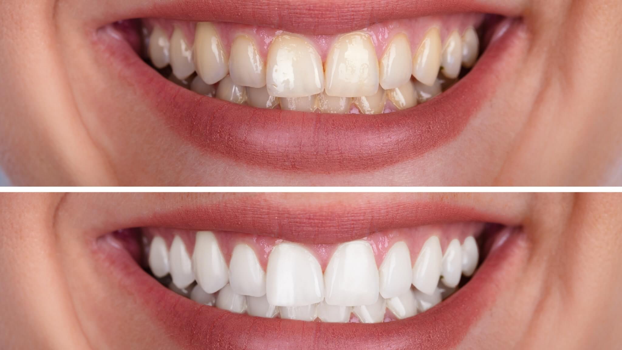 Teeth Whitening Last