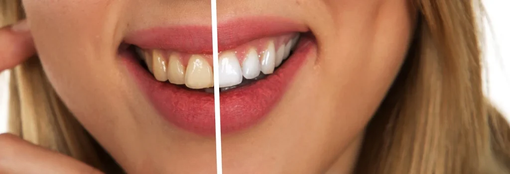 Teeth Whitening Last