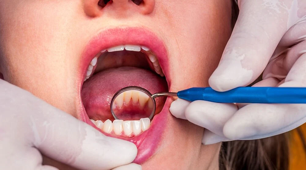 Dental Cleanings