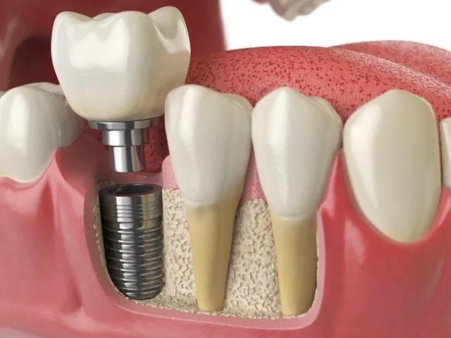 How Long Do Dental Implants Last?