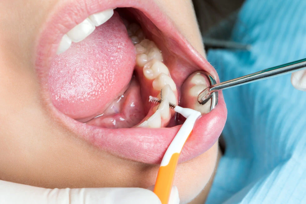 Dental Cleanings