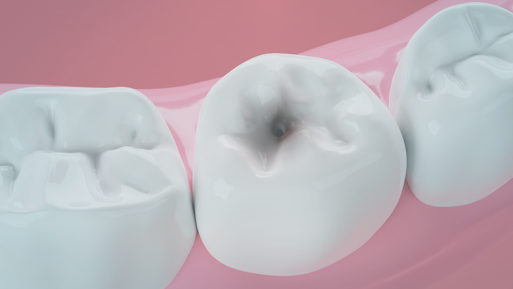 Image of a tooth with a gap next to a tooth restored with a composite filling. 