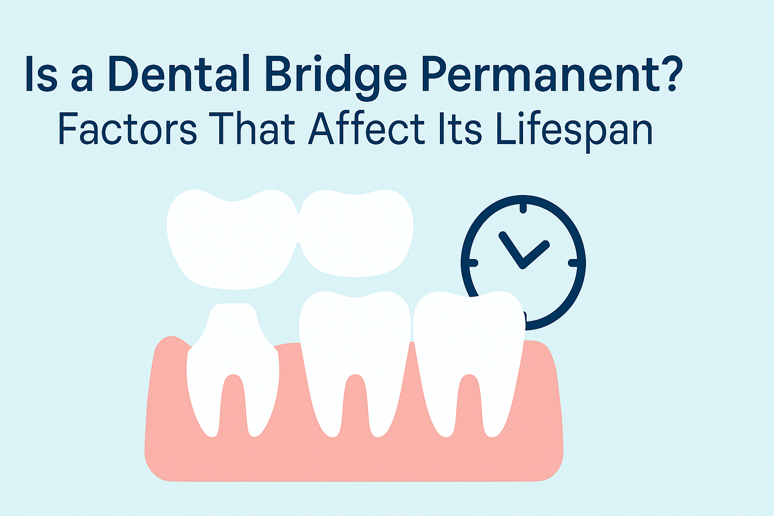 Dental bridge lifespan