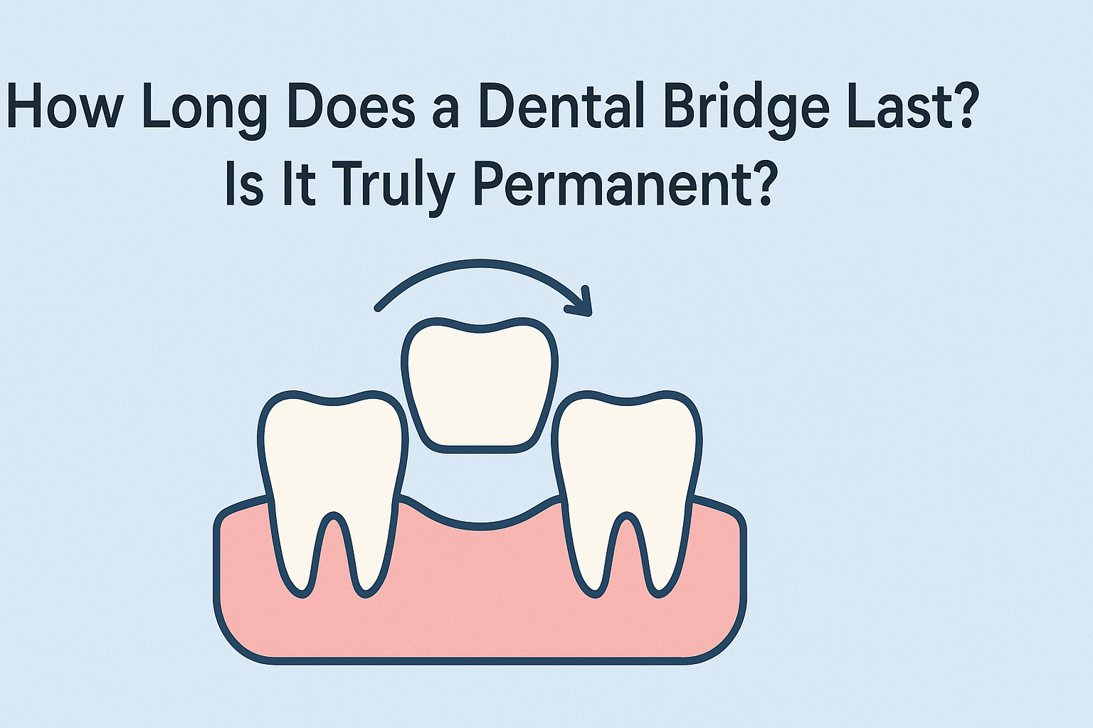 how long do dental bridges last