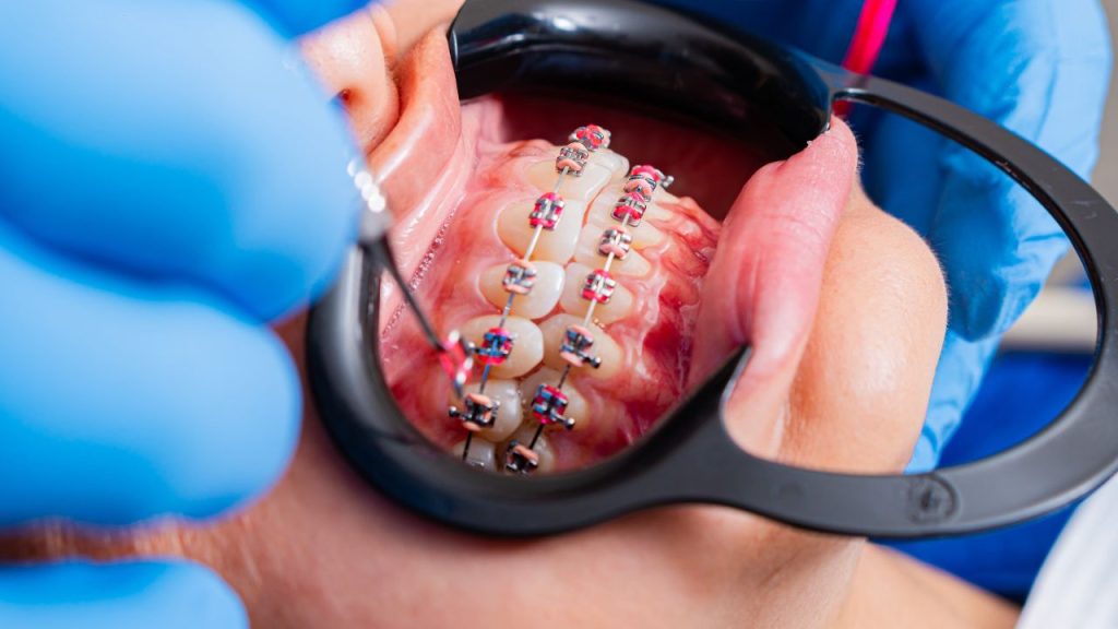 how long does dental bonding take