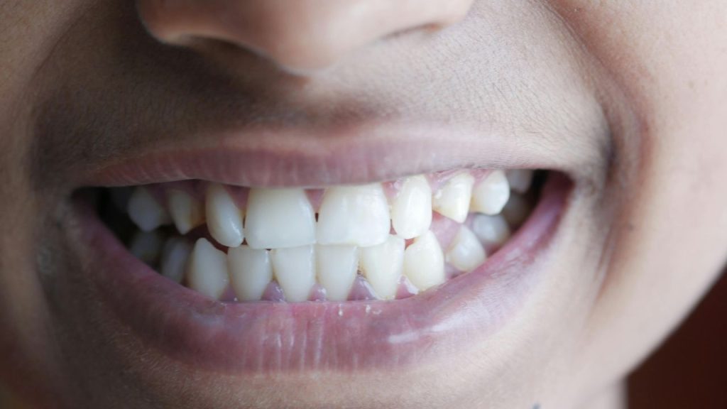 dental cleaning for gum disease